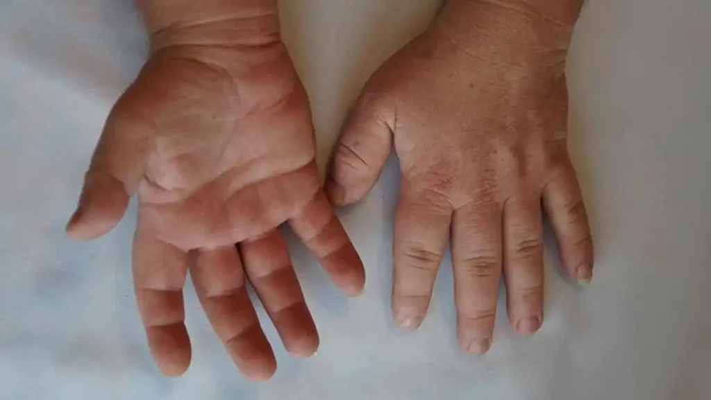 Acromegalia: La Importancia de la Detección Temprana en una Enfermedad Rara