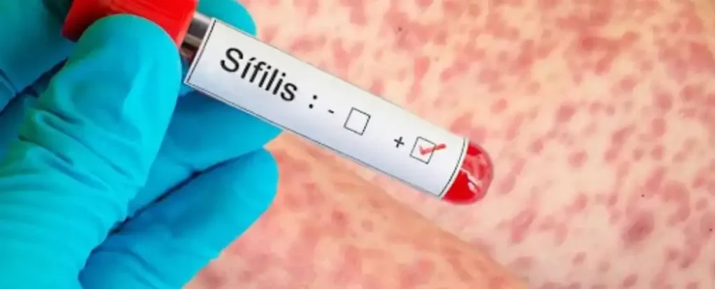 Aumento Alarmante de Casos de Sífilis en Argentina: Un Desafío para la Salud Pública